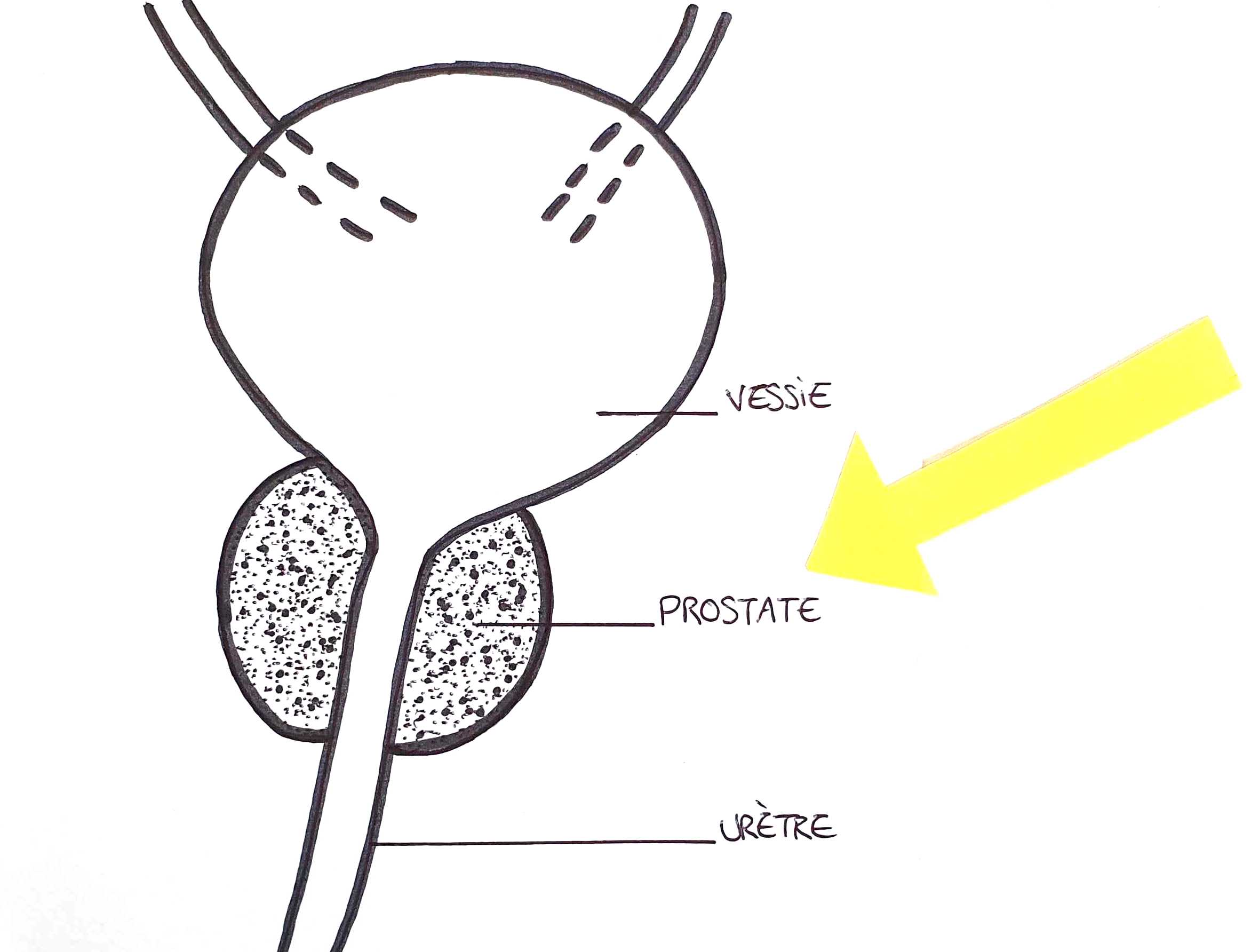 schéma prostate
